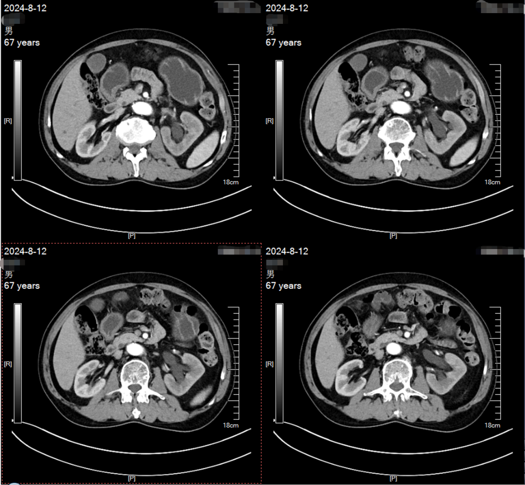Application of ADC Drugs in Organ Preservation for High-Risk Non-Muscle Invasive Urothelial Carcinoma Patients
