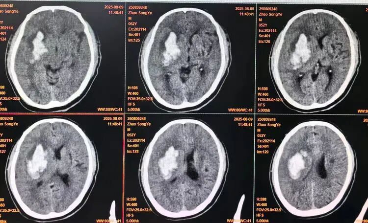 How 3D Printing Enables One-Click Customization of Minimally Invasive Hemorrhage Solutions