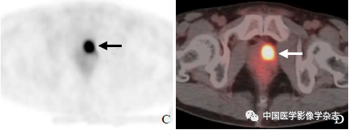 The Value of miPSMA Scoring in Diagnosing Prostate Cancer Using (68)Ga-PSMA-11 PET/CT Imaging