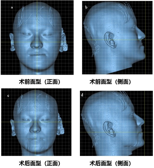Digital Design and 3D Printing Technology in the Treatment of Malocclusion