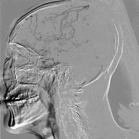 Application of the C-Balloon® Catheter Combined with the PathGuard® Umbrella for Endovascular Treatment of Floating Thrombus at the Carotid Artery Bifurcation