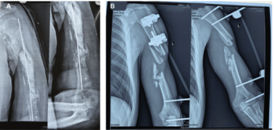 3D Printing of PEEK (Polyether Ether Ketone) for Treating Humeral Fractures Caused by Gunshot Wounds in the Russia-Ukraine War