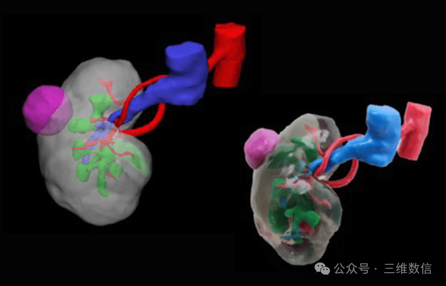 3D Printing of Kidney Tumors Could Transform Kidney Cancer Research