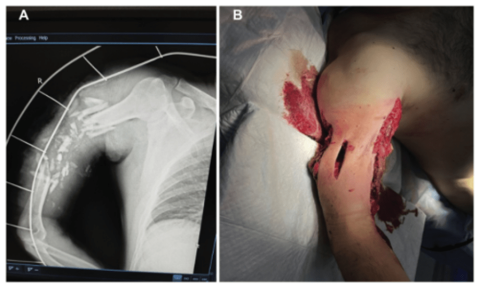 3D Printing of PEEK (Polyether Ether Ketone) for Treating Humeral Fractures Caused by Gunshot Wounds in the Russia-Ukraine War