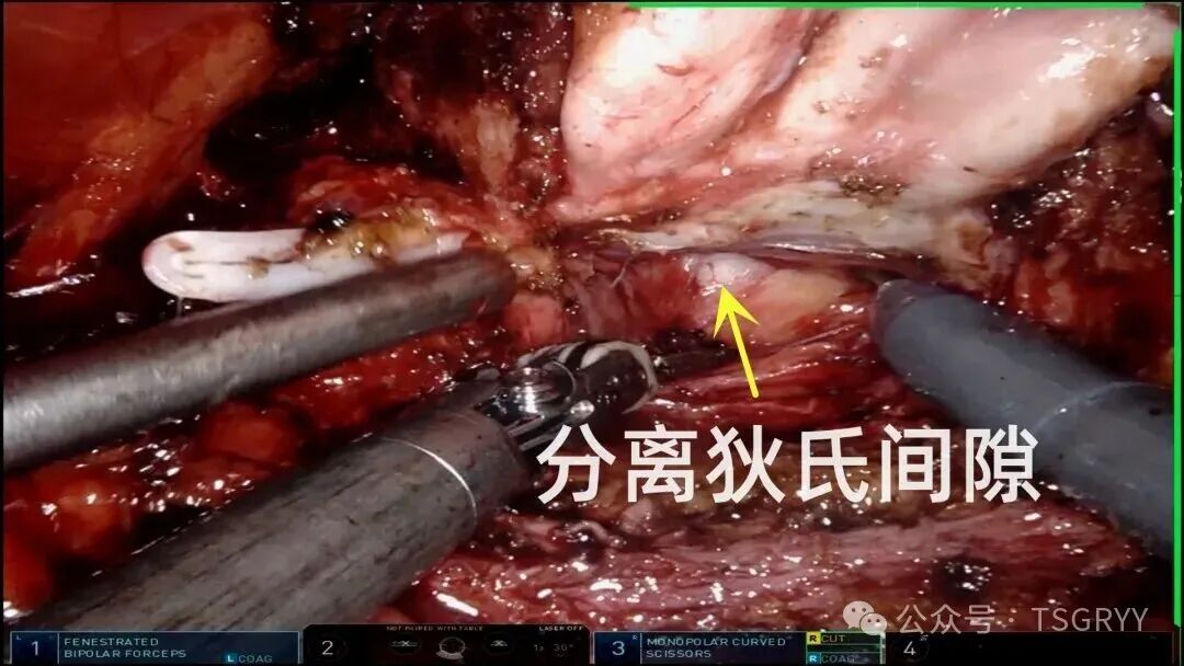 Precision Minimally Invasive Surgery: Safeguarding Life's Glands