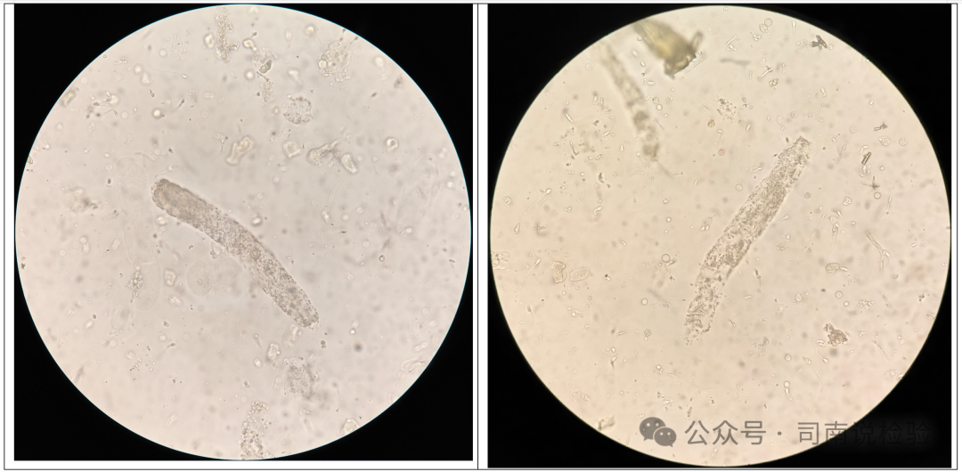 Morphology 127: Urine - Granular Casts (Instrument-Assisted Diagnosis)
