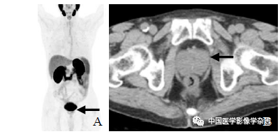 The Value of miPSMA Scoring in Diagnosing Prostate Cancer Using (68)Ga-PSMA-11 PET/CT Imaging