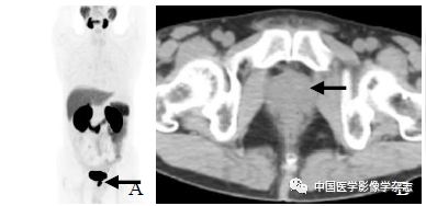 The Value of miPSMA Scoring in Diagnosing Prostate Cancer Using (68)Ga-PSMA-11 PET/CT Imaging