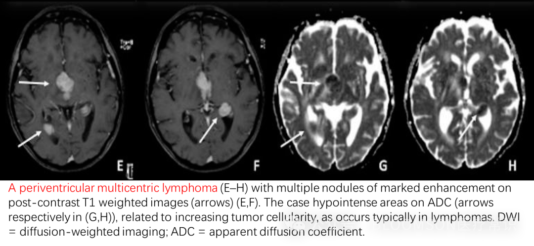 Overview of DWI and ADC Values in MRI