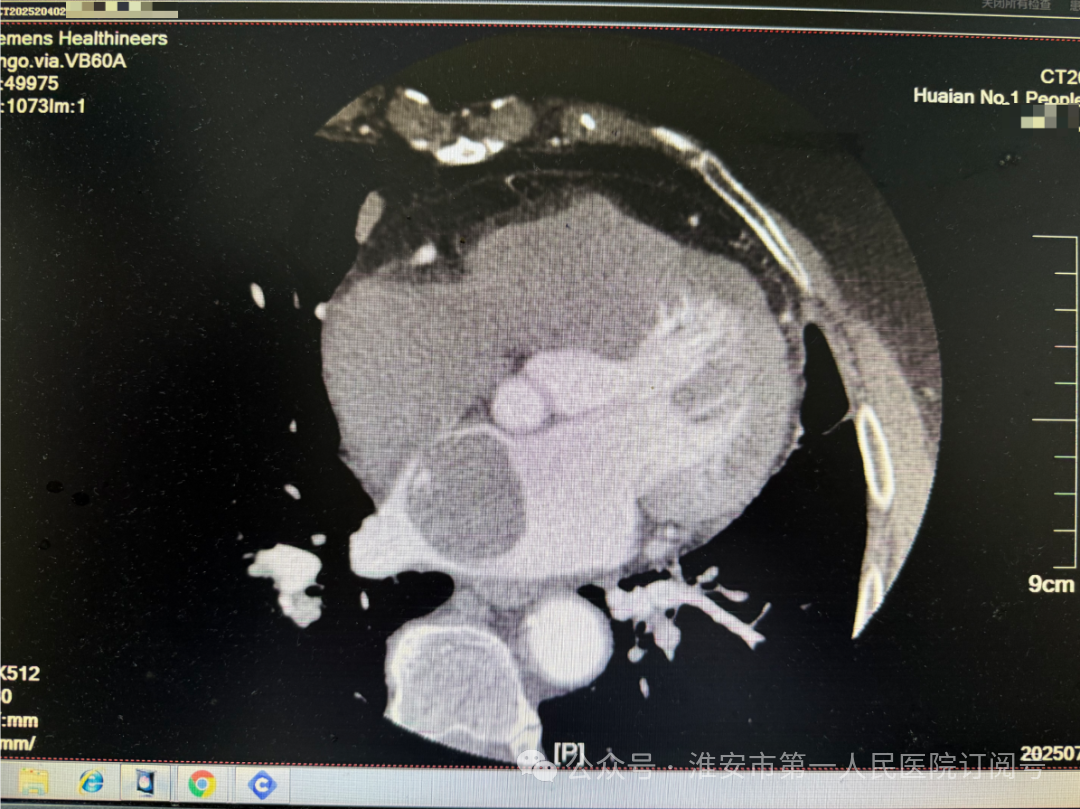 Cutting-Edge Medical Technology: Da Vinci Robot-Assisted Heart Tumor Resection Without Thoracotomy