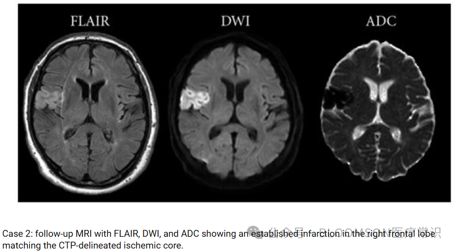 Overview of DWI and ADC Values in MRI