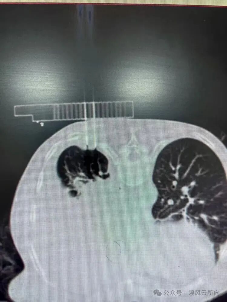 Minimally Invasive Tumor Techniques Series - 3D Printed Coplanar Template-Assisted Radioactive Particle Implantation
