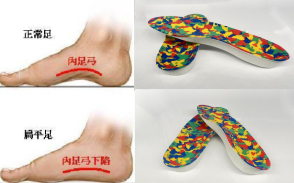 Customizing Foot Arches: The Revolution of 3D Printing