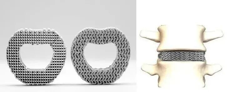 3D Printing of Silicon Nitride Ceramic Artificial Vertebrae: Achieving Personalized Customization of Biomimetic Bone Structures