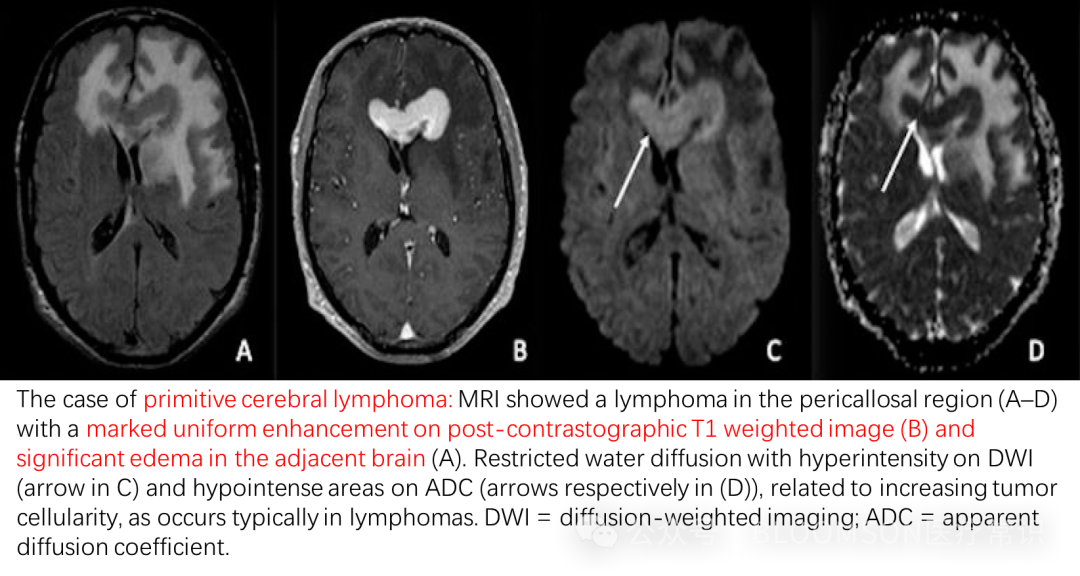 Overview of DWI and ADC Values in MRI