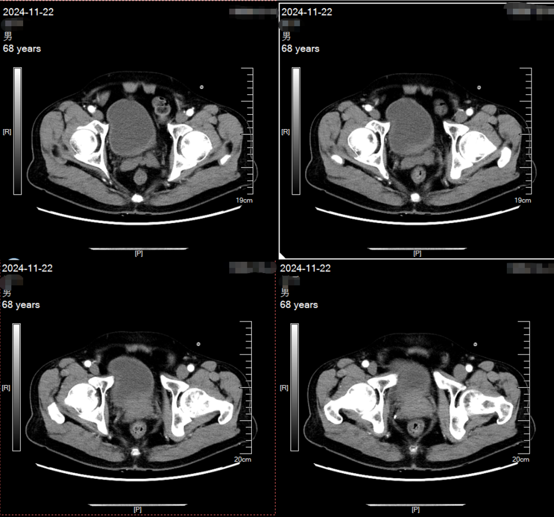 Application of ADC Drugs in Organ Preservation for High-Risk Non-Muscle Invasive Urothelial Carcinoma Patients