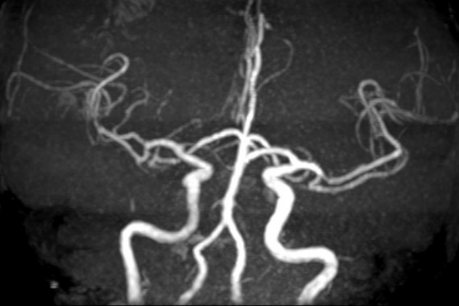 Application of the C-Balloon® Catheter Combined with the PathGuard® Umbrella for Endovascular Treatment of Floating Thrombus at the Carotid Artery Bifurcation