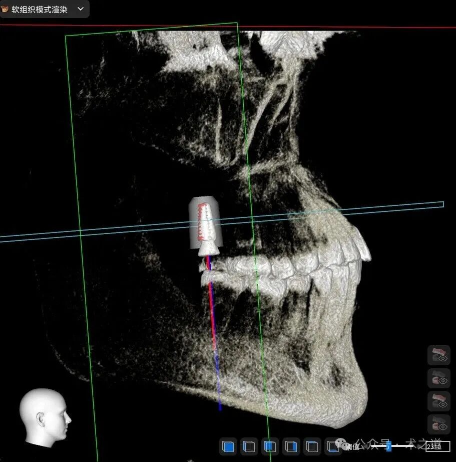 Advantages of the 'ZhiZhi π' Dental Implant Robot-Assisted Implantation Technology in the Maxillary Molar Region
