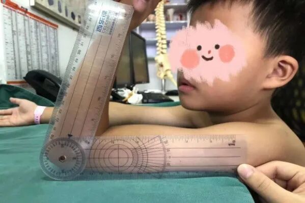 What to Do When an Arm is Bent? 3D Printing Achieves a "Personalized Custom" Solution