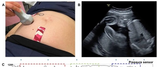 New Breakthrough in Fetal Movement Monitoring During Pregnancy! A Sensor the Size of a Band-Aid for Accurate Maternal and Infant Safety
