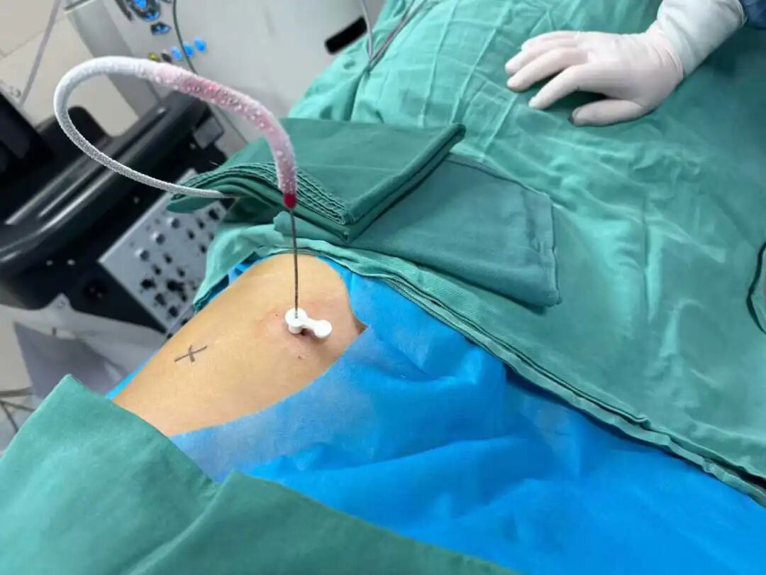 When AI Robots Meet Cryoablation: Lung Nodules Precisely Frozen with a Single Injection!