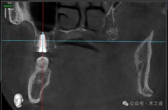 Advantages of the 'ZhiZhi π' Dental Implant Robot-Assisted Implantation Technology in the Maxillary Molar Region