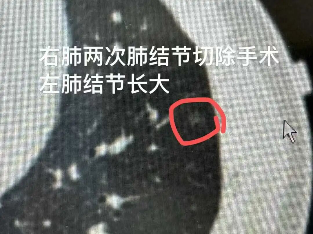 When AI Robots Meet Cryoablation: Lung Nodules Precisely Frozen with a Single Injection!