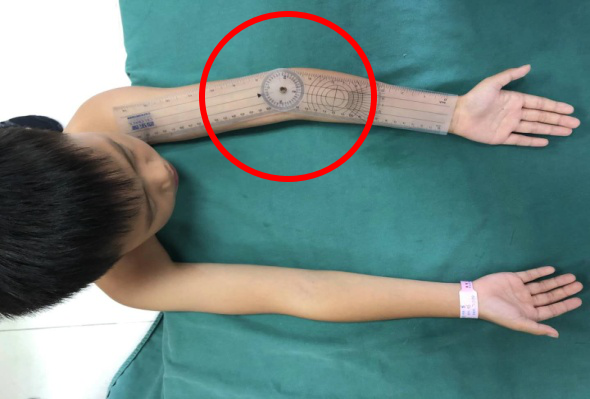 What to Do When an Arm is Bent? 3D Printing Achieves a "Personalized Custom" Solution