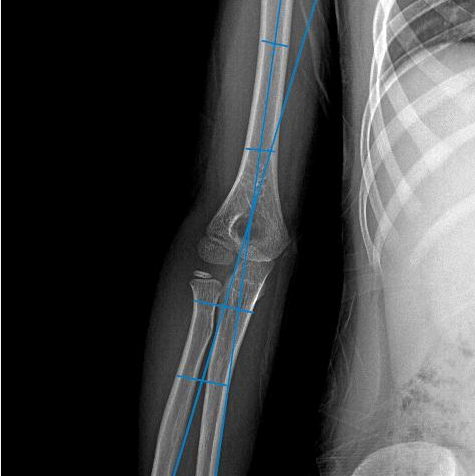 What to Do When an Arm is Bent? 3D Printing Achieves a "Personalized Custom" Solution