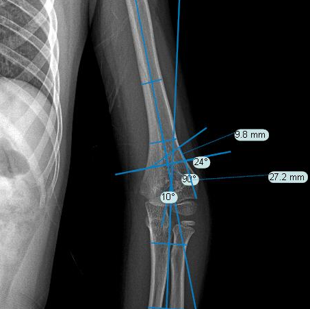 What to Do When an Arm is Bent? 3D Printing Achieves a "Personalized Custom" Solution