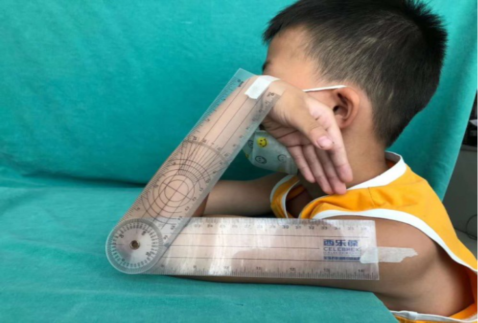 What to Do When an Arm is Bent? 3D Printing Achieves a "Personalized Custom" Solution