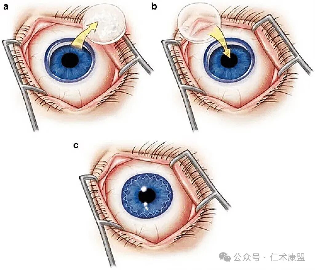 Impact of Successful 3D Printed Corneal Transplant Cases on the Medical Industry and Analysis of Related Companies at Home and Abroad