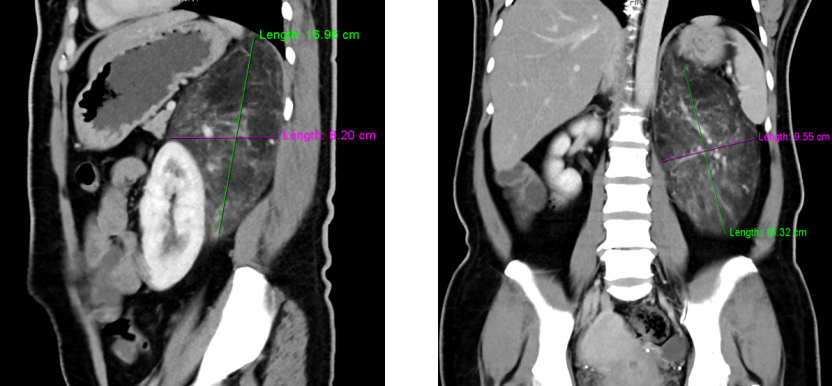 Da Vinci Robot Precisely Performs Tumor Resection | Urology Team at Zhongshan First Hospital Successfully Removes Large Tumor from Patient's Left Kidney Area