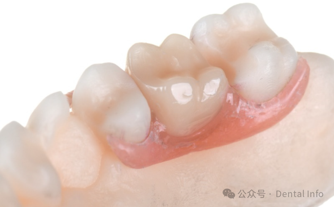 Comparative Study on the Fabrication of Fixed Partial Dentures Using Different 3D Printing Technologies