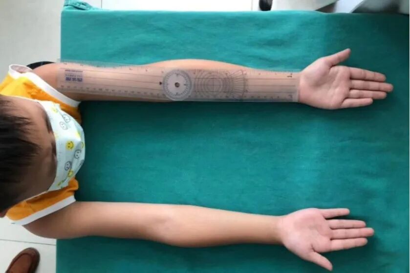 What to Do When an Arm is Bent? 3D Printing Achieves a "Personalized Custom" Solution