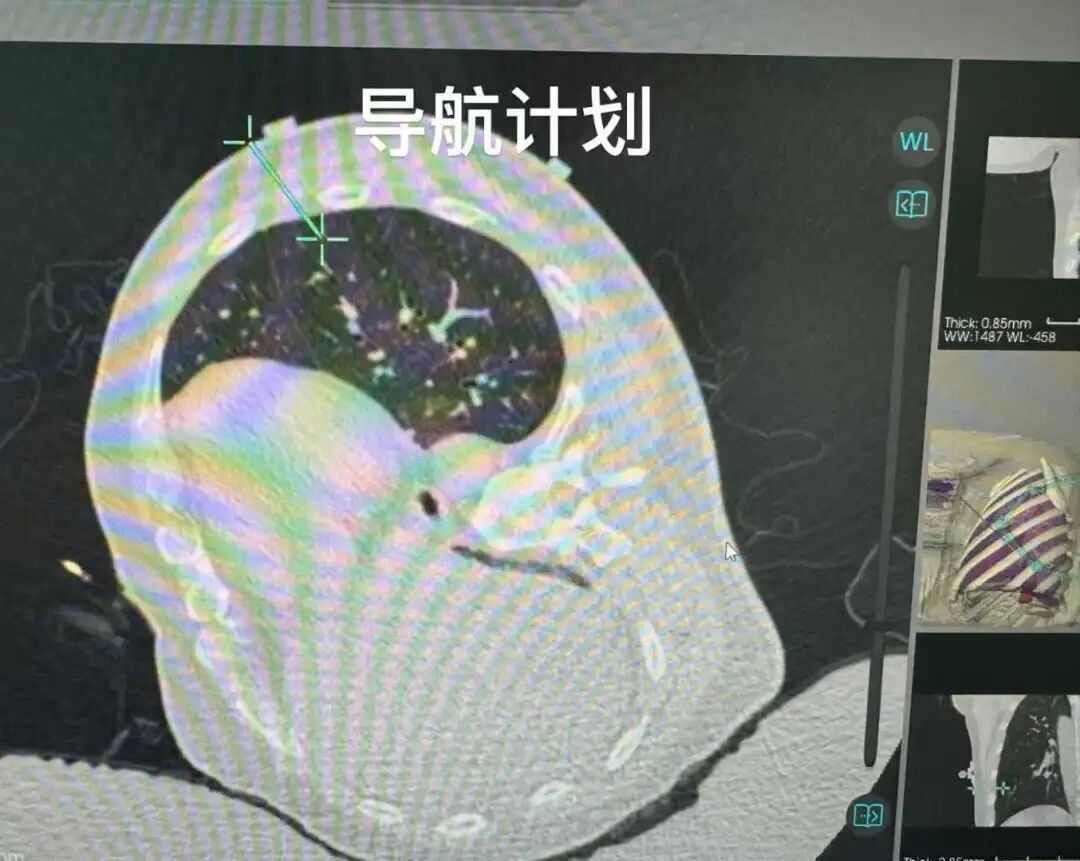 When AI Robots Meet Cryoablation: Lung Nodules Precisely Frozen with a Single Injection!