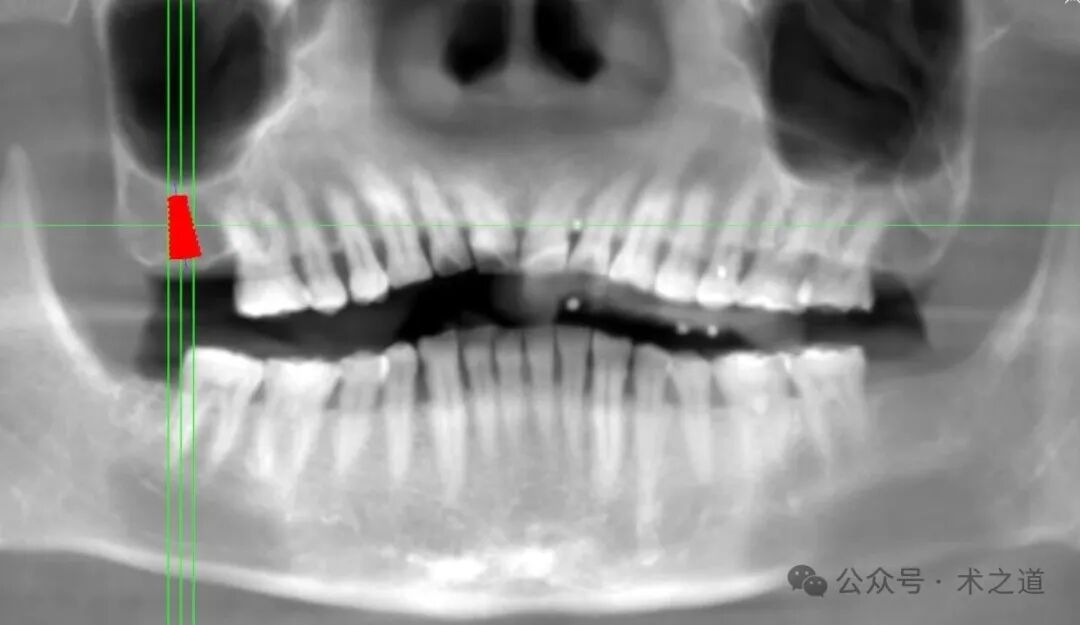 Advantages of the 'ZhiZhi π' Dental Implant Robot-Assisted Implantation Technology in the Maxillary Molar Region