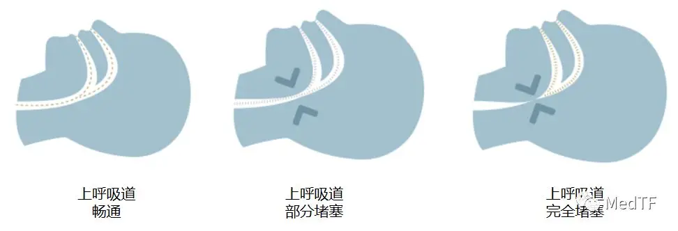 Somnair: The Invisible Dental Appliance That Can Treat Snoring