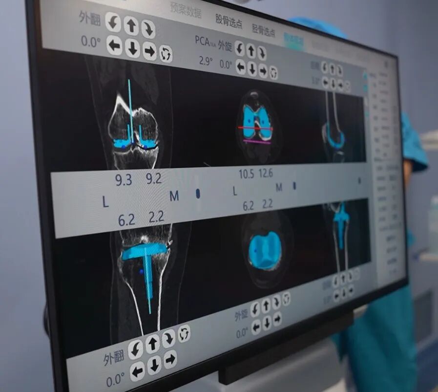 The Future is Here! AI Orthopedic Robots Achieve Human-Machine Collaboration