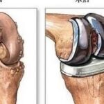 AI-Driven Design and 3D Printing for Personalized Knee Joint Replacement: Achieving Precision Medicine