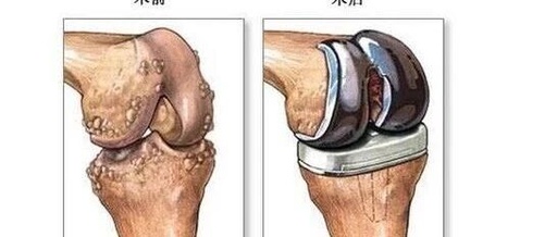 AI-Driven Design and 3D Printing for Personalized Knee Joint Replacement: Achieving Precision Medicine