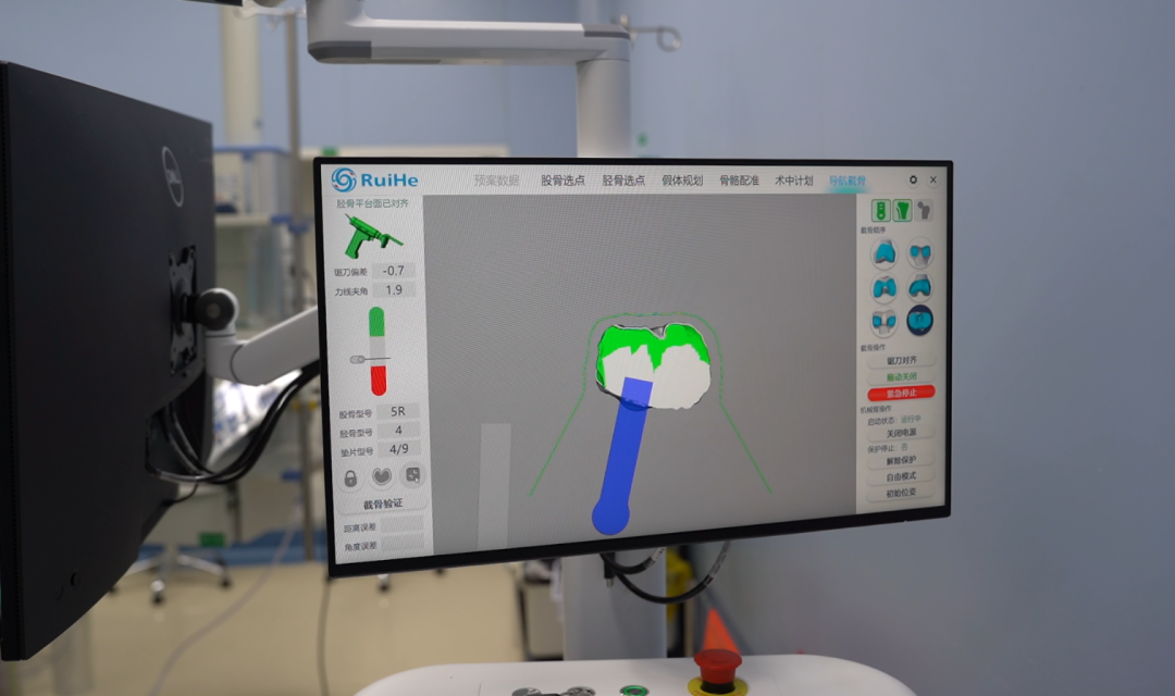 The Future is Here! AI Orthopedic Robots Achieve Human-Machine Collaboration