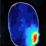 AI-Assisted Focused Ultrasound Surgical Robot