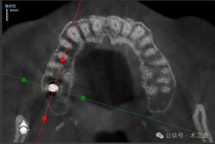 Advantages of the 'ZhiZhi π' Dental Implant Robot-Assisted Implantation Technology in the Maxillary Molar Region