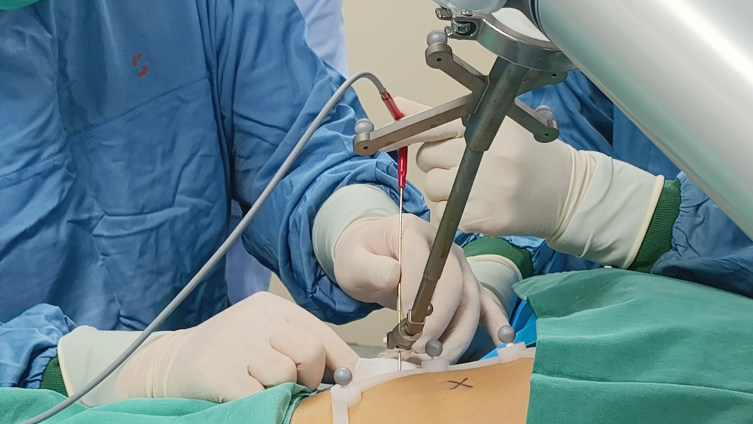 When AI Robots Meet Cryoablation: Lung Nodules Precisely Frozen with a Single Injection!