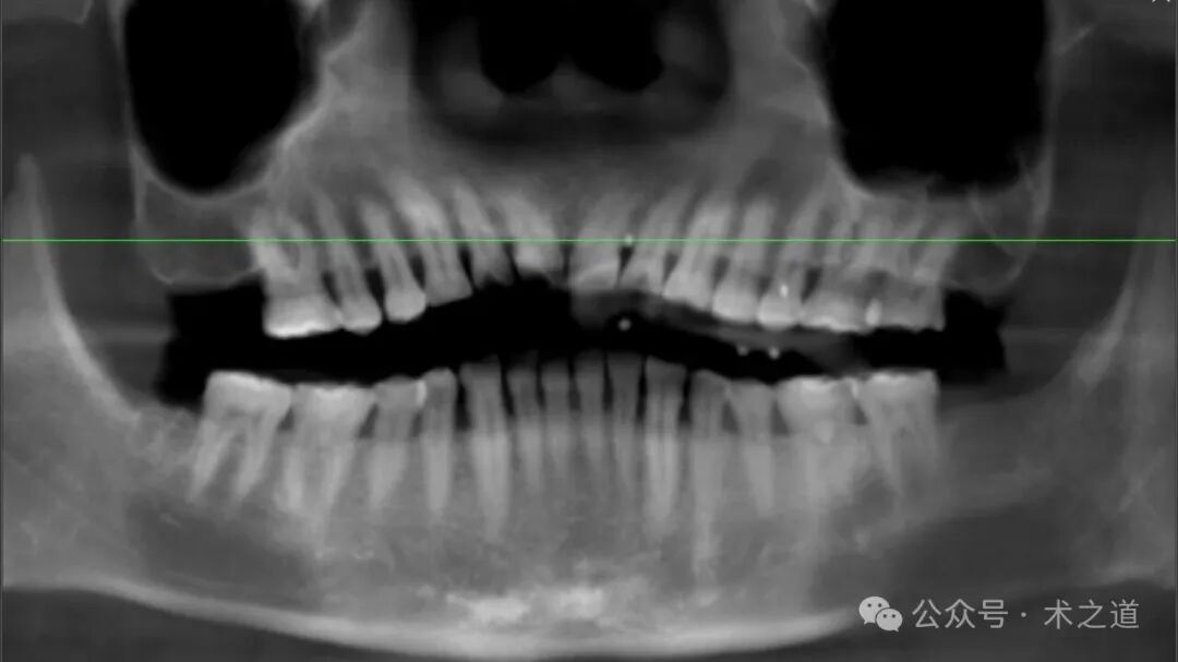 Advantages of the 'ZhiZhi π' Dental Implant Robot-Assisted Implantation Technology in the Maxillary Molar Region