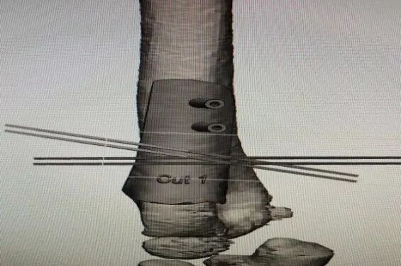 What to Do When an Arm is Bent? 3D Printing Achieves a "Personalized Custom" Solution