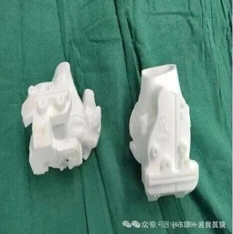 AI-Driven Design and 3D Printing for Personalized Knee Joint Replacement: Achieving Precision Medicine