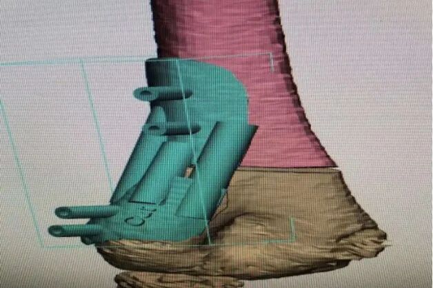 What to Do When an Arm is Bent? 3D Printing Achieves a "Personalized Custom" Solution