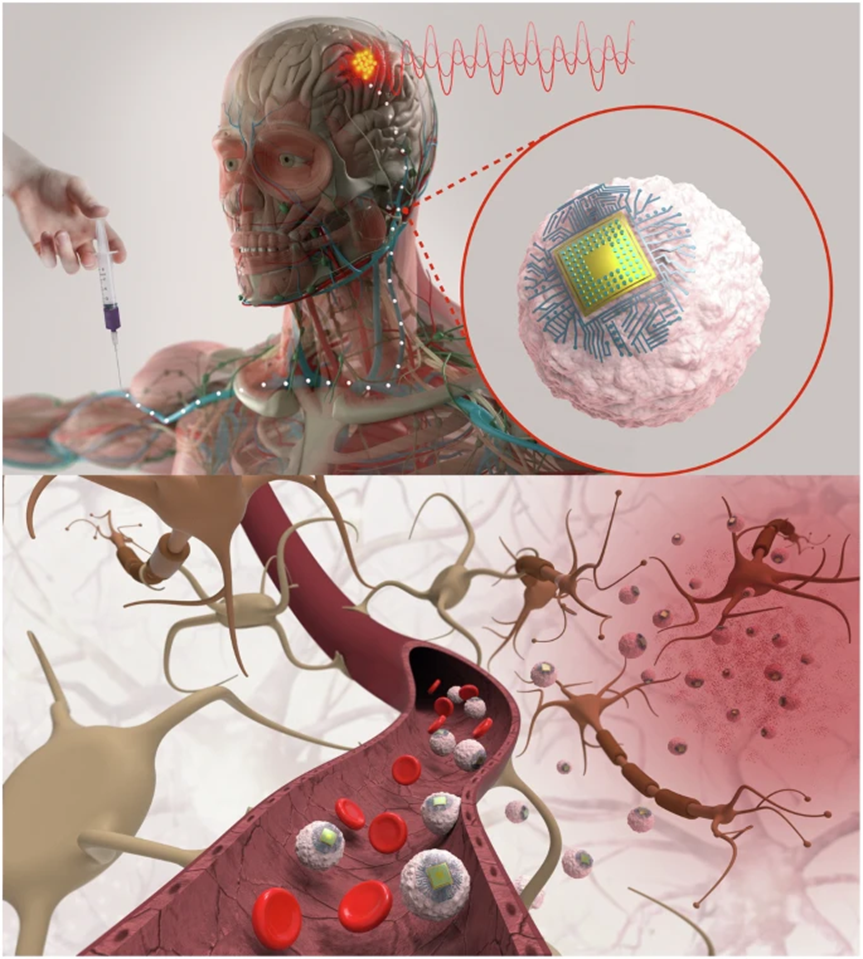 Definition of Injectable Brain Chip Technology